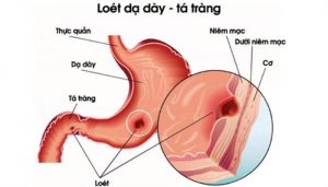 Nguyên nhân gây xuất huyết dạ dày