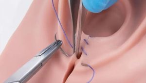 Chỉ Tự Tiêu Là Gì ? Ứng Dụng  của chỉ tự tiêu Trong Phẫu Thuật, Thẩm Mỹ