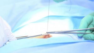 Có nên tự ý cắt chỉ không tiêu tại nhà không?