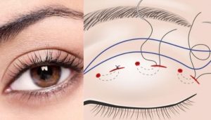 Ứng dụng của chỉ tự tiêu trong phẫu thuật, thẩm mỹ